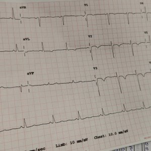 ecg shared by drashha.jpeg